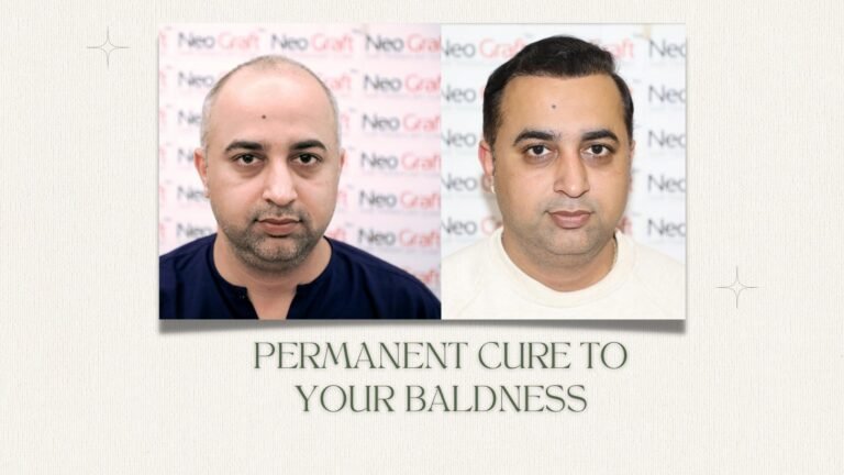 permanent cure to your baldness