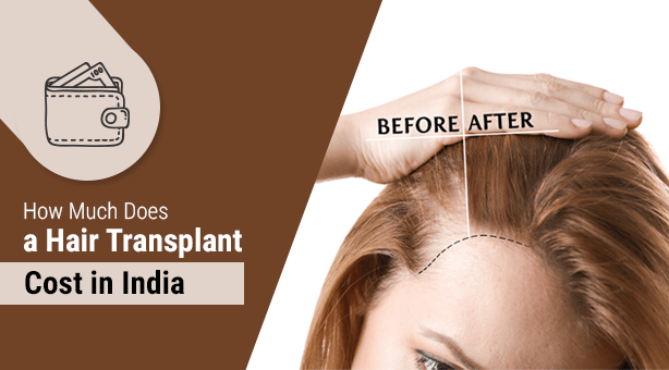 Best Bio Synthetic Hair Implant Cost in Delhi | Artificial Hair Implant