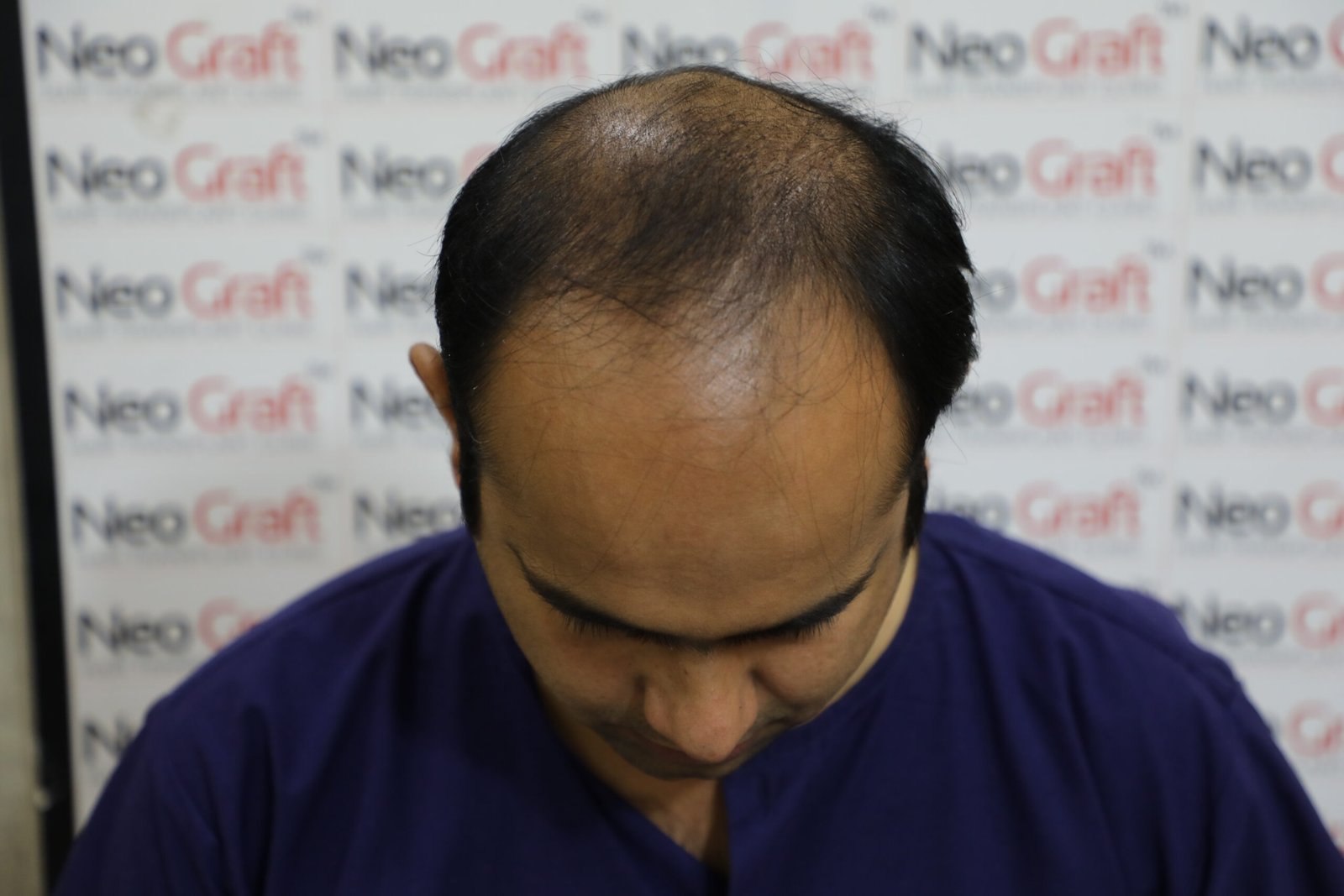 hair transplant neograft hair clinic chandigarh